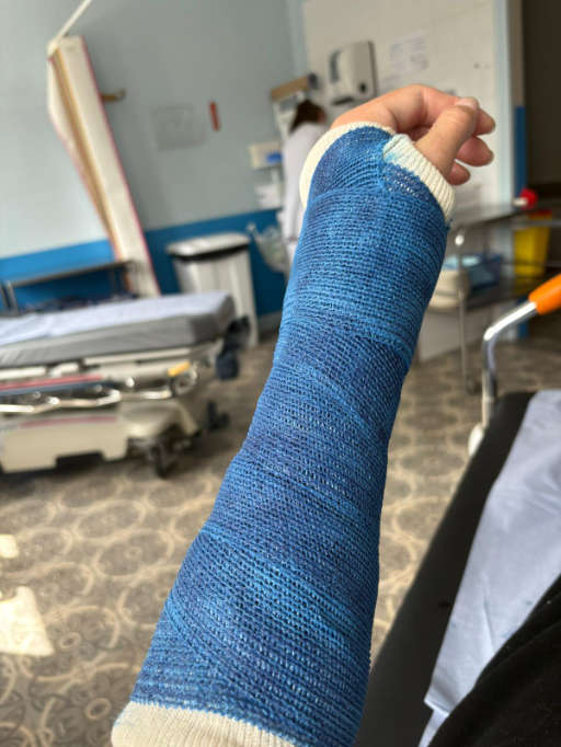 Kath's broken arm